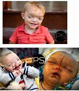 Image result for Encephalocele Before and After