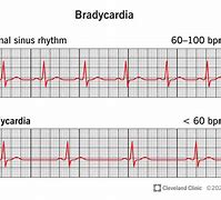 bradycardia 的图像结果