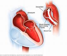 Image result for Signs of Aortic Aneurysm