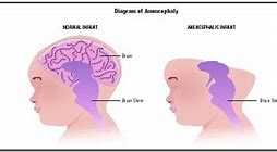 Image result for Anencephaly Brain Diagram