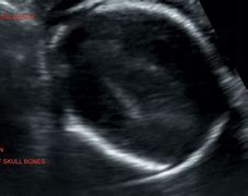 Image result for Intrauterine Fetal Death 2nd Trimester