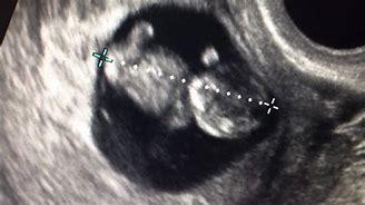 Image result for 9 Week Abdominal Ultrasound