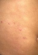 Image result for Molluscum Contagiosum Pictures Early Stages