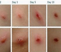 Image result for First Symptoms of Chickenpox