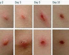 Image result for Chickenpox Child