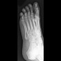 Image result for Child Foot Fold