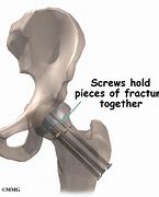 Image result for Hip Pinning Surgery