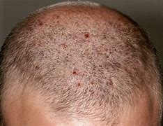 Image result for Small Bumps On Scalp