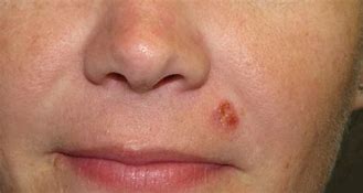 Image result for Squamous Cell Skin Cancer Surgery