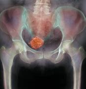 Image result for 8 Cm Fibroid Weigh