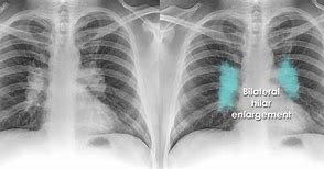 Image result for Hilar Nodule Lung