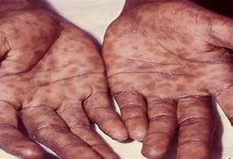 Image result for Syphilis Rash On Hands