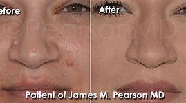 Image result for Mole Removal Procedure