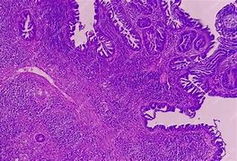Image result for Pedunculated Papilloma