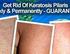 Image result for Keratosis Pilaris Removal