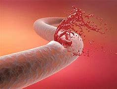 Image result for arteriosclerosis