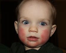 Image result for Fifth Disease Diagnosis