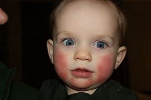 Image result for Fifth Disease Child
