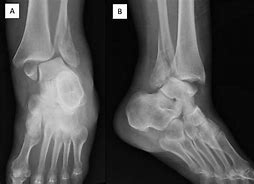 Image result for Broken and Dislocated Ankle