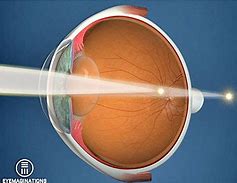 Image result for Astigmatism Laser Eye Surgery