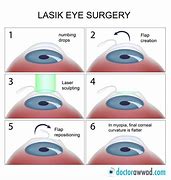 Image result for Lasik