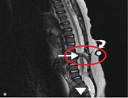 Image result for Spina Bifida Occulta X-ray