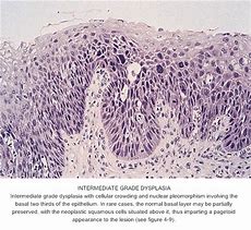 Image result for High Grade Squamous Dysplasia