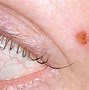 Image result for Sebaceous Cyst On Eyelid
