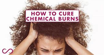 Image result for Hair Dye Chemical Burn