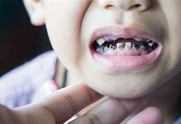 Image result for Little Kids Rotten Teeth