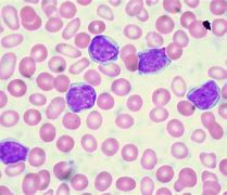 Image result for What Is Leukemia