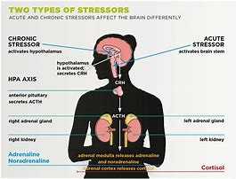 Image result for Acute Stress Brain