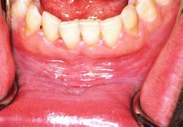 Image result for Gingival Leukoplakia