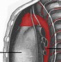 Image result for Dissecting Aortic Aneurysm
