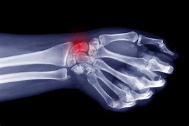 Image result for Wrist Watch Injury