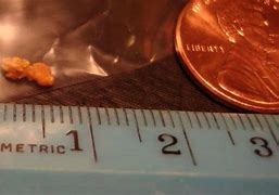Image result for 6 mm Kidney Stone