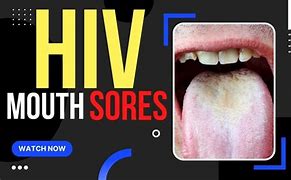 Image result for HIV Canker Sore