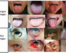 Image result for Anaemia Pallor