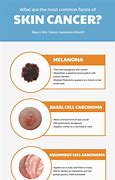 Image result for Types of Skin Cancer Names