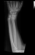 Image result for Broken Arm