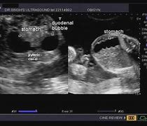 Image result for Double Bubble Fetal Ultrasound