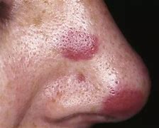 Image result for Bacillary Angiomatosis vs Kaposi Sarcoma