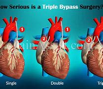 Image result for What Is a Triple Bypass