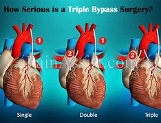 Image result for Triple Bypass Surgery