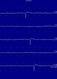 Image result for Positive Sharp Waves EMG