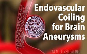 Image result for Aneurysm Coiling Model