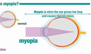 Image result for Myopia Example
