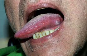 Image result for Squamous Papilloma Oral Lesion