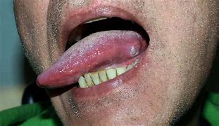 Image result for Squamous Cell Carcinoma Tongue Cancer