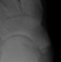 Image result for Oblique Fracture 5th Metatarsal